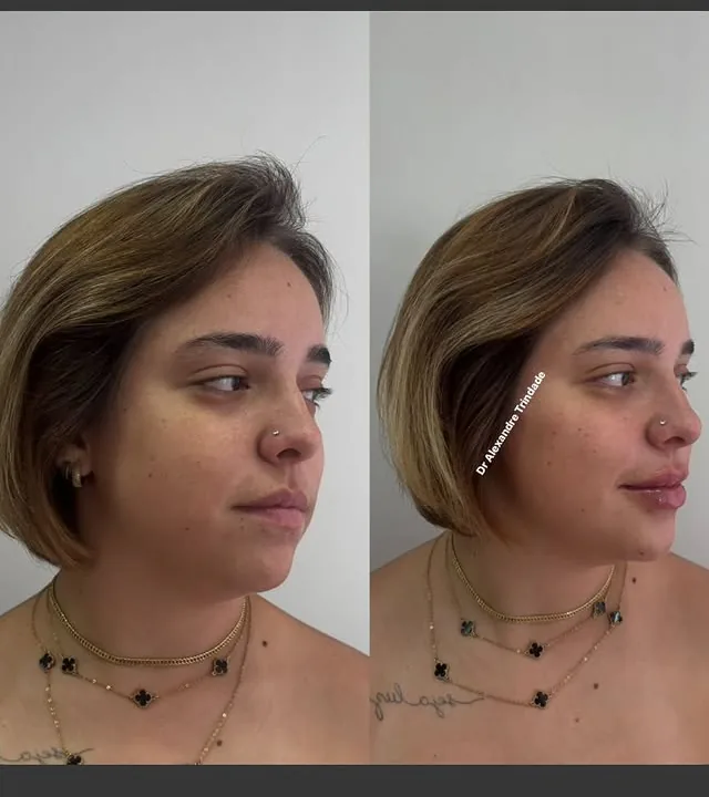 Preenchimento Labial